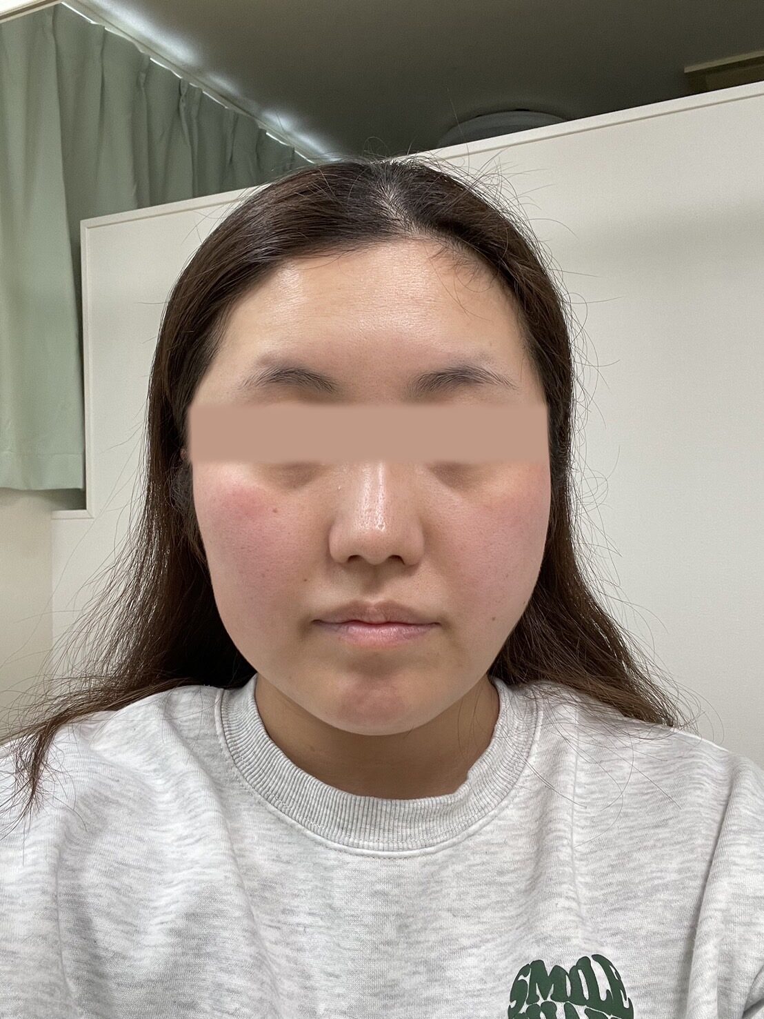 アフター