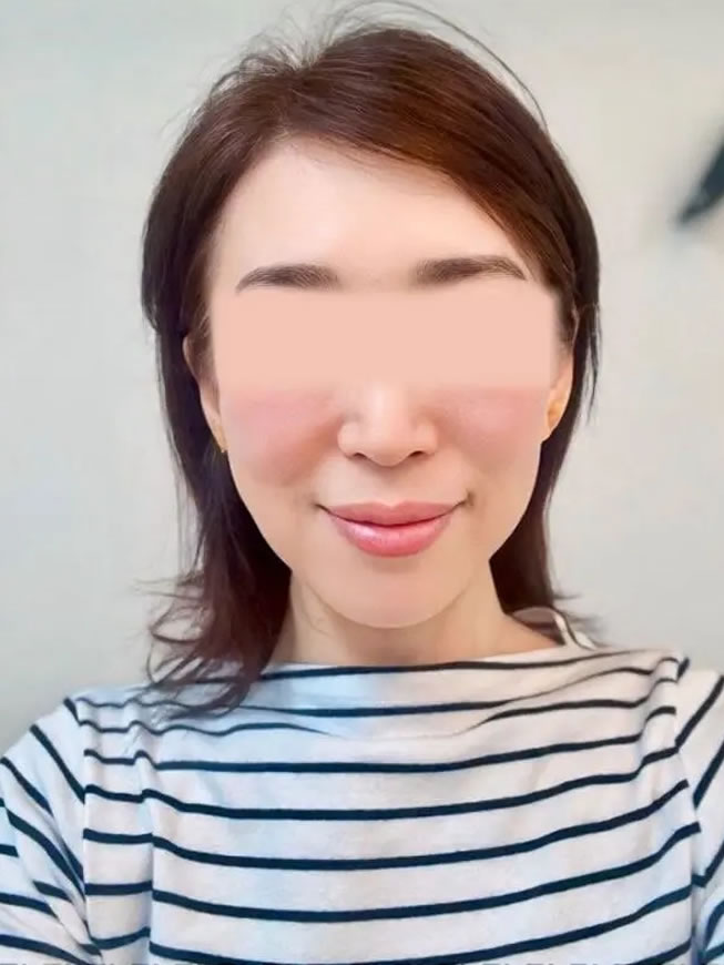 小顔矯正・美容鍼アフター