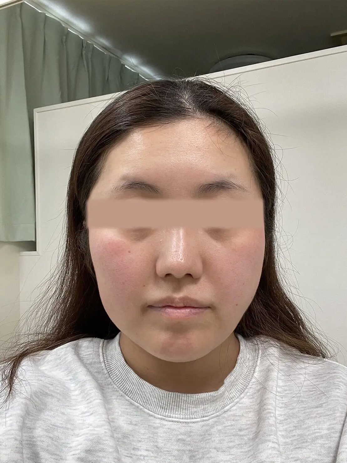 小顔矯正・美容鍼ショート・LEDセラピー・水素吸入 アフター